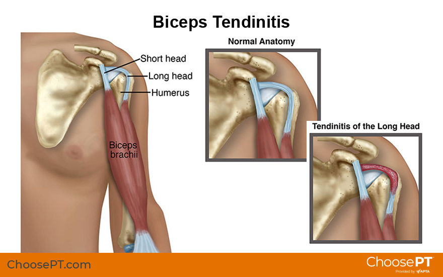 Illustration of biceps tendinitis
