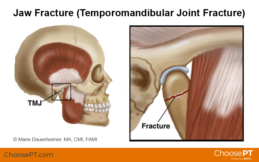 Jaw fracture illustration