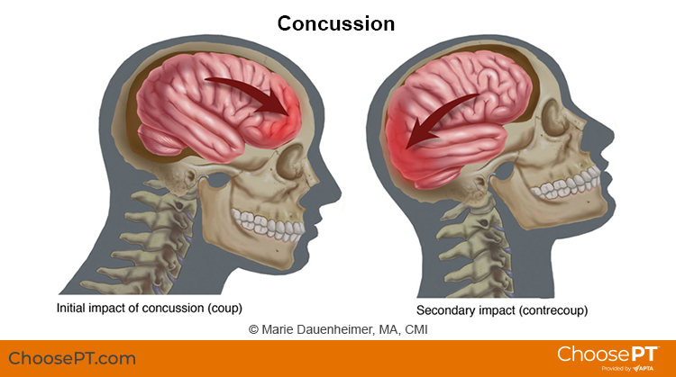 Concussion Illustration