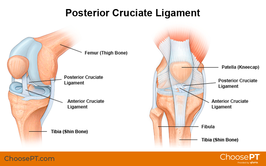 Illustration of posterior tibial tendon dysfunction (acquired flat foot)