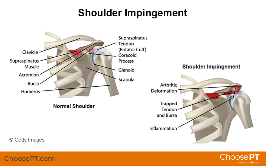 Illustration of shoulder impingement syndrome